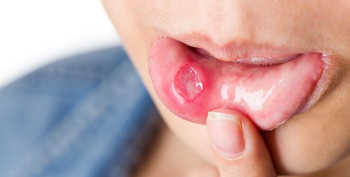 quelles sont les solutions pour traiter les aphtes,2018