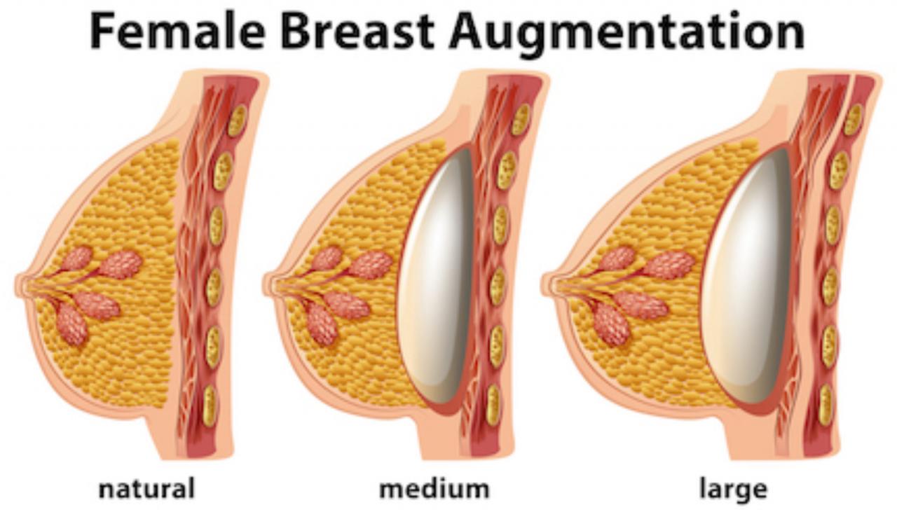 Augmentation mammaire naturelle: comment ça marche?