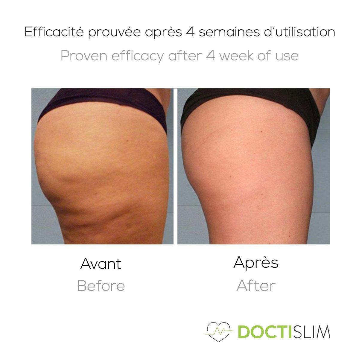 Cellulite, quelles solutions ?